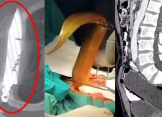 Veja os itens inusitados encontrados dentro de corpo de pacientes Teve até DIU 'desaparecido' por 12 anos...