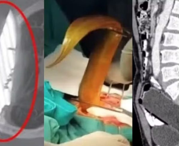 Veja os itens inusitados encontrados dentro de corpo de pacientes Teve até DIU 'desaparecido' por 12 anos...
